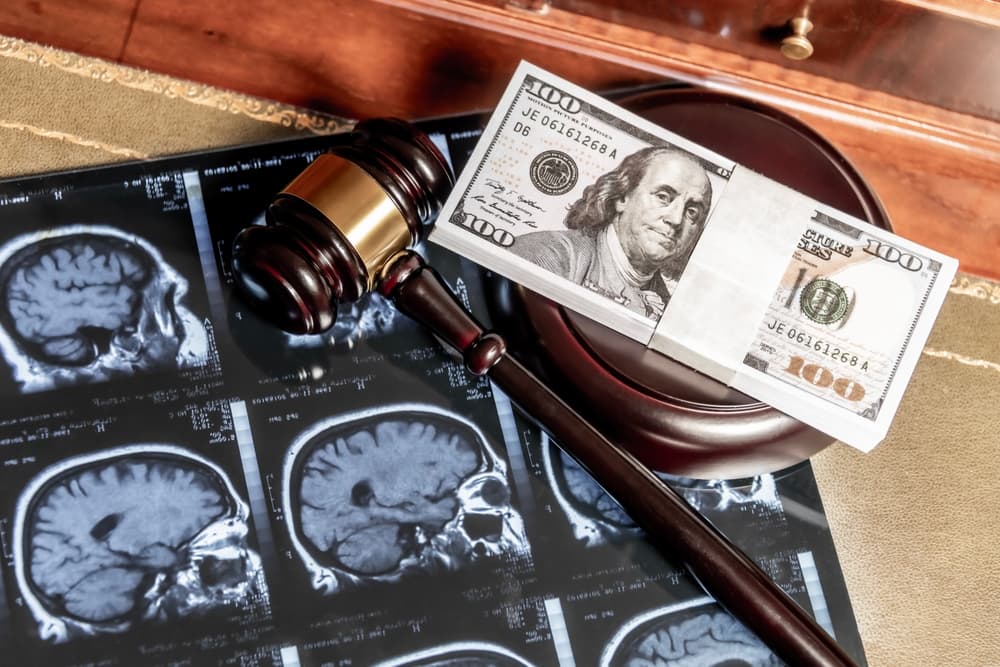 A gavel and money placed on a brain scan image symbolize legal compensation.